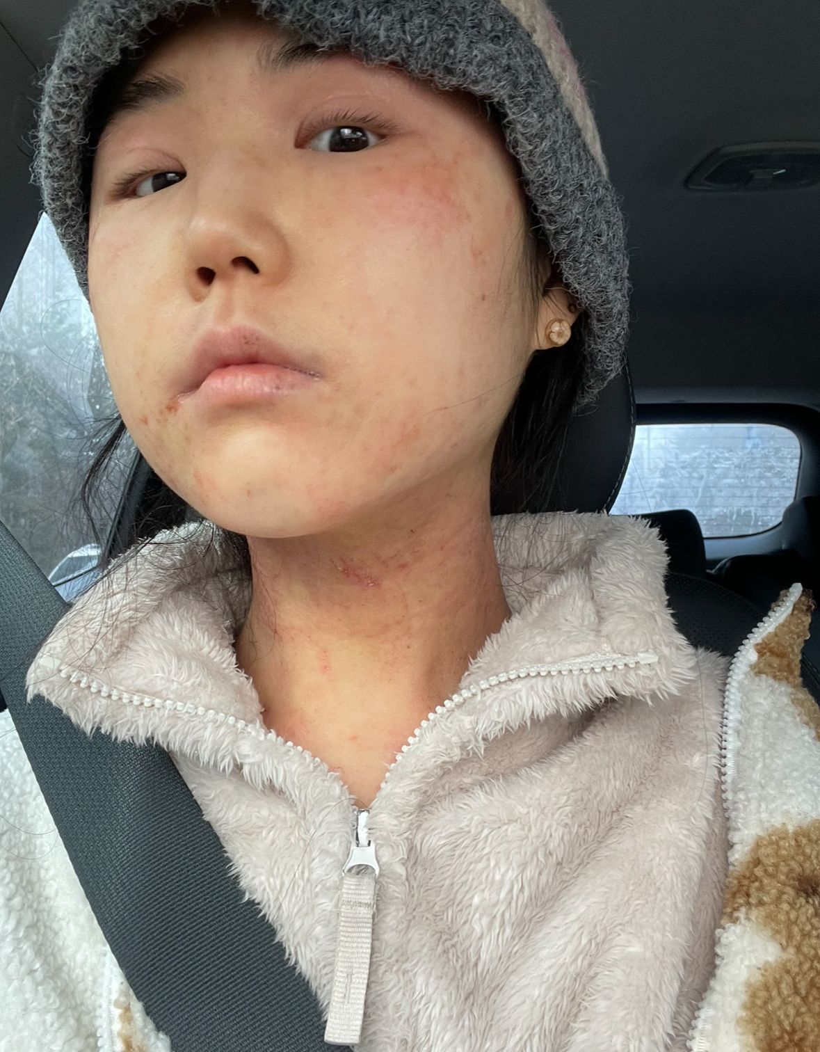 여름에는 땀과 열로 인해, 겨울에는 건조함으로 아토피 피부염 증상이 심해진다.